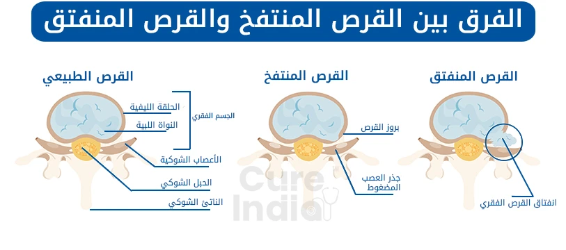 ما هو الفرق بين الانزلاق الغضروفي وانتفاخ القرص؟